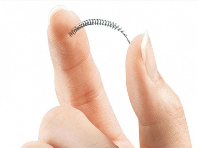 implant essure